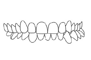 Crossbite