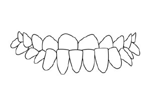 Underbite